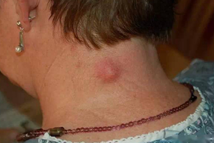 毛发囊肿后颈小红疙瘩图