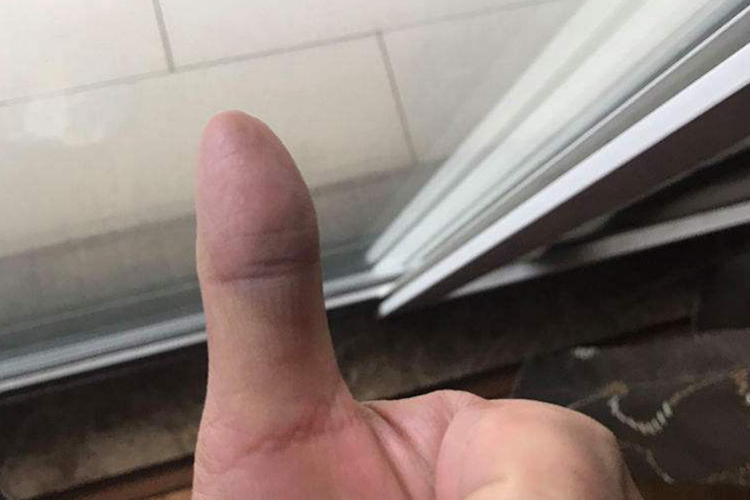 大拇指淤血图 大拇指淤血图