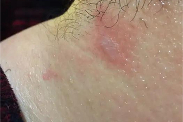 二度烫伤颈部小水疱图 二度烫伤颈部小水疱图