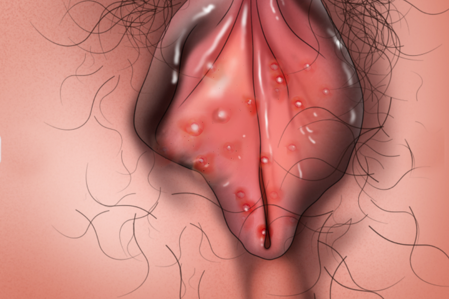 外阴疱疹病毒感染图 外阴疱疹病毒感染图