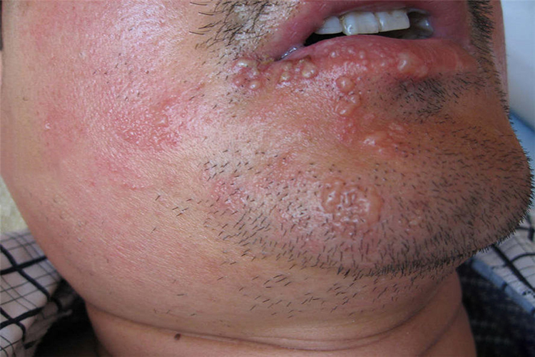 唇部带状疱疹初期图