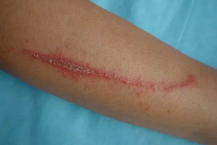 隐翅虫皮炎胳膊症状图