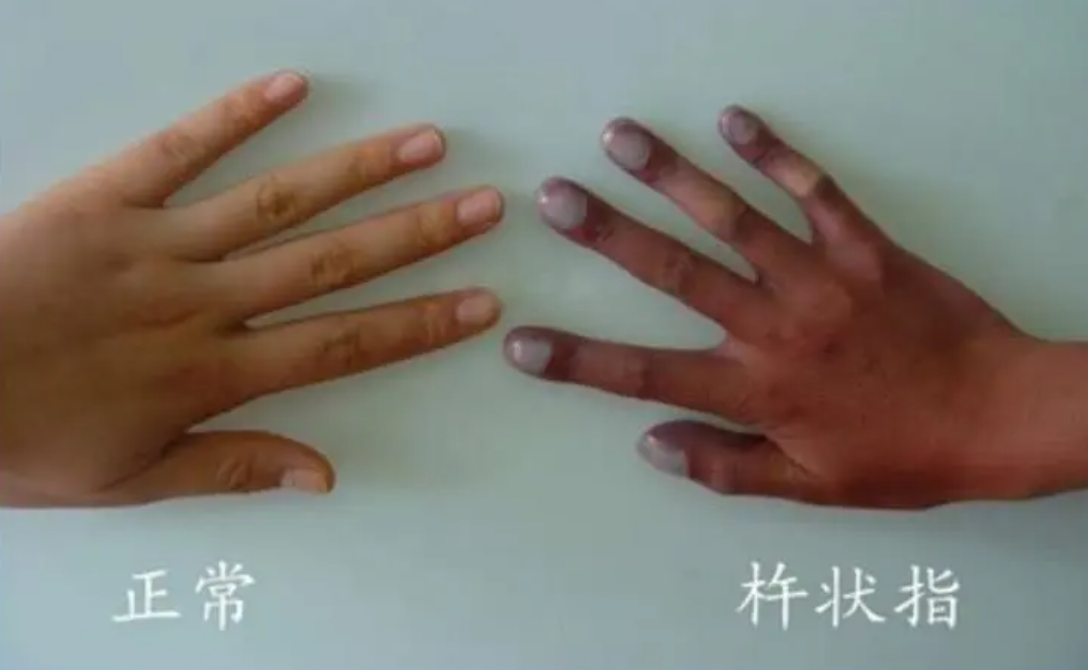 儿童杵状指的鉴别图