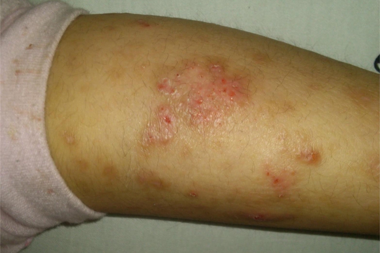 慢性湿疹小腿小红疙瘩图 慢性湿疹小腿小红疙瘩图