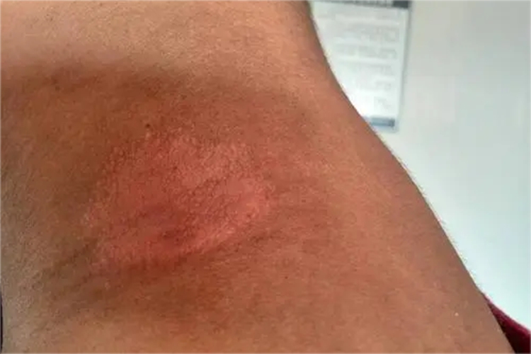 日照性皮炎侧颈黑斑图