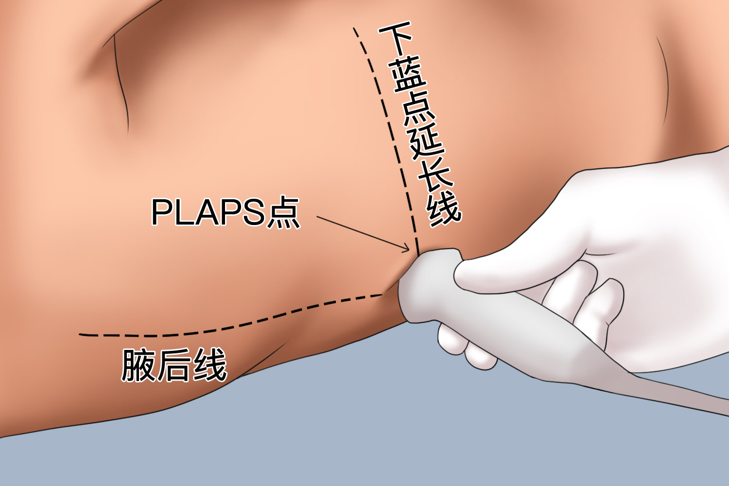 PLAPS点示意图