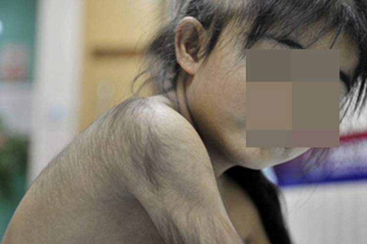 多毛症胳膊上有一层长毛图