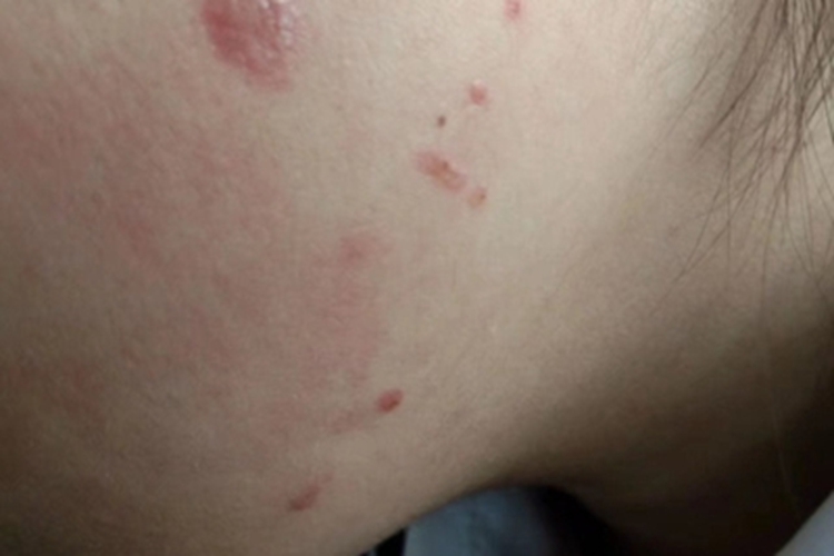 非大疱型脓疱疮面部长红斑图