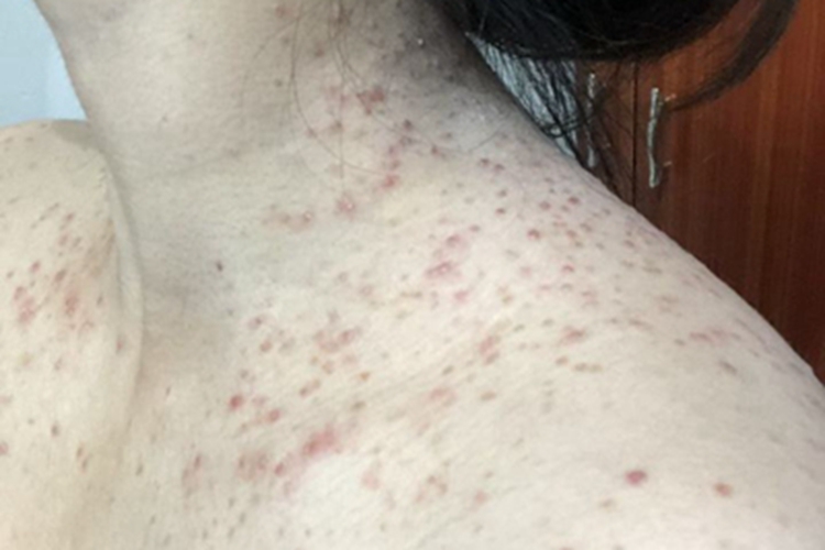 马拉色菌毛囊炎肩部丘疹图