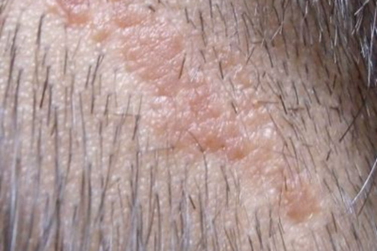 皮脂腺痣头上斑块发红图