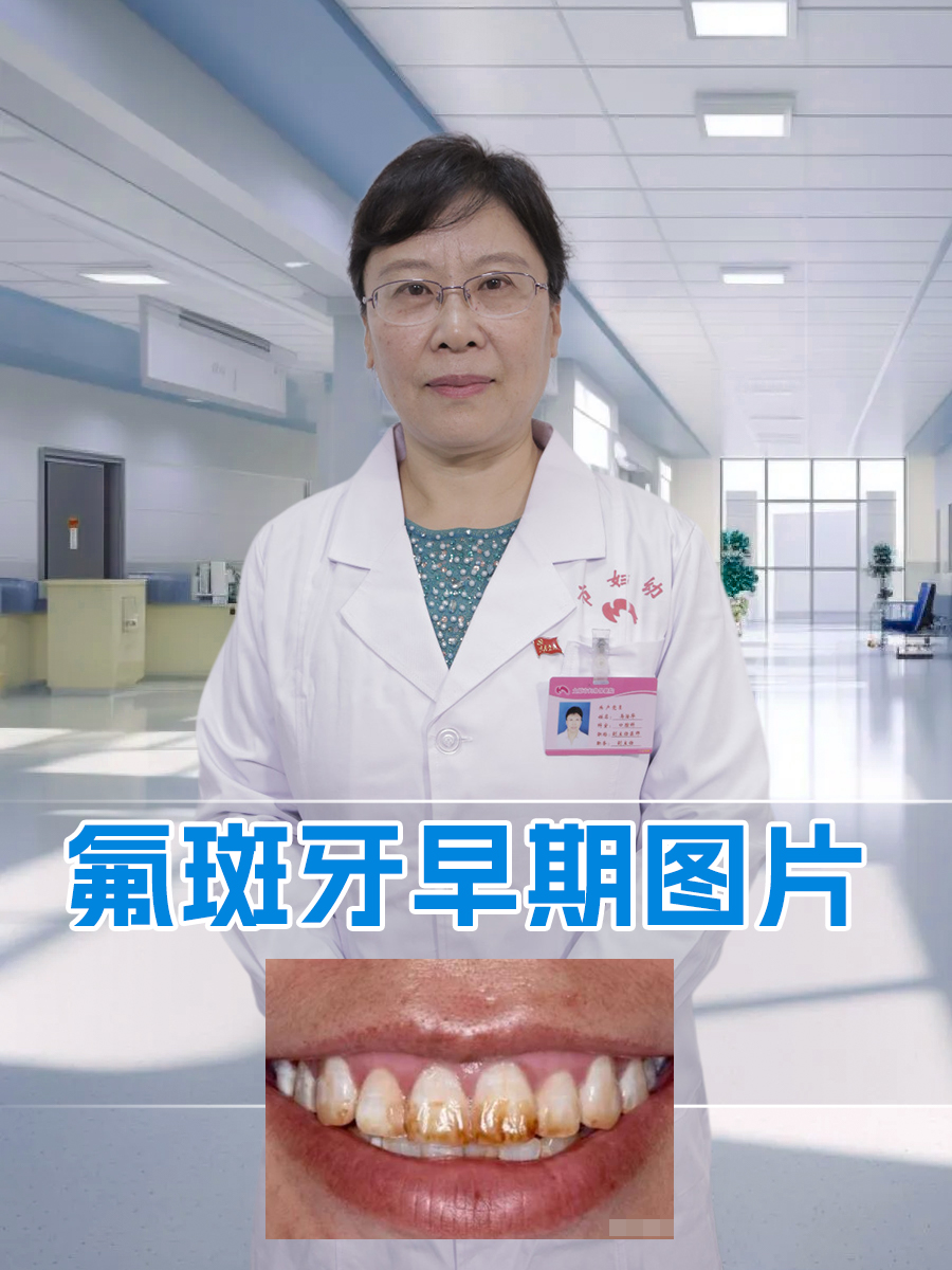 氟斑牙早期图片