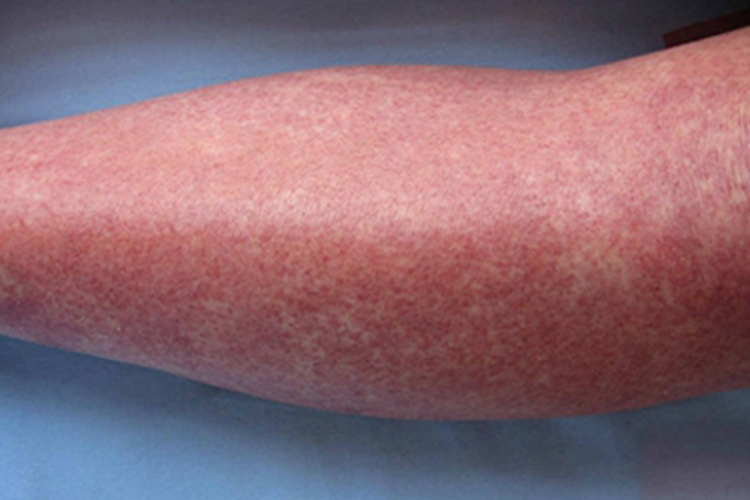 紫癜型药疹小腿症状图