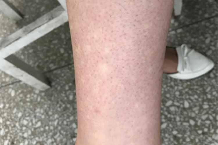 结节性硬化症小腿白斑图 结节性硬化症小腿白斑图