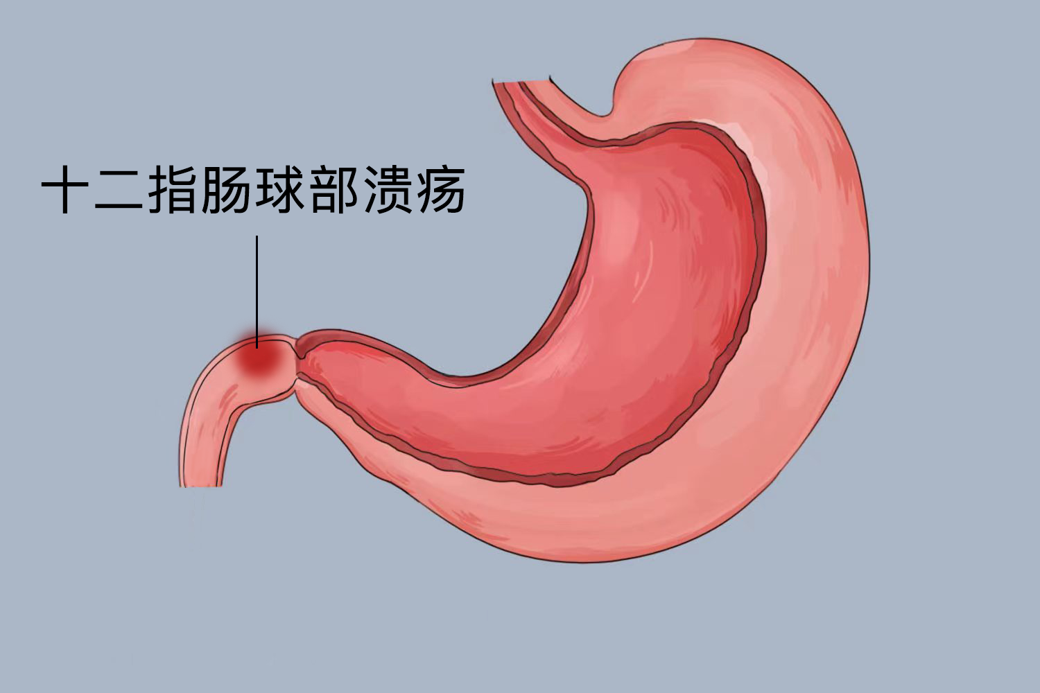 十二指肠球部溃疡位置图