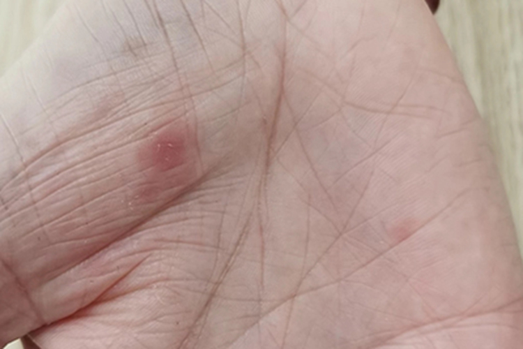 斑疹性梅毒疹手掌红斑图