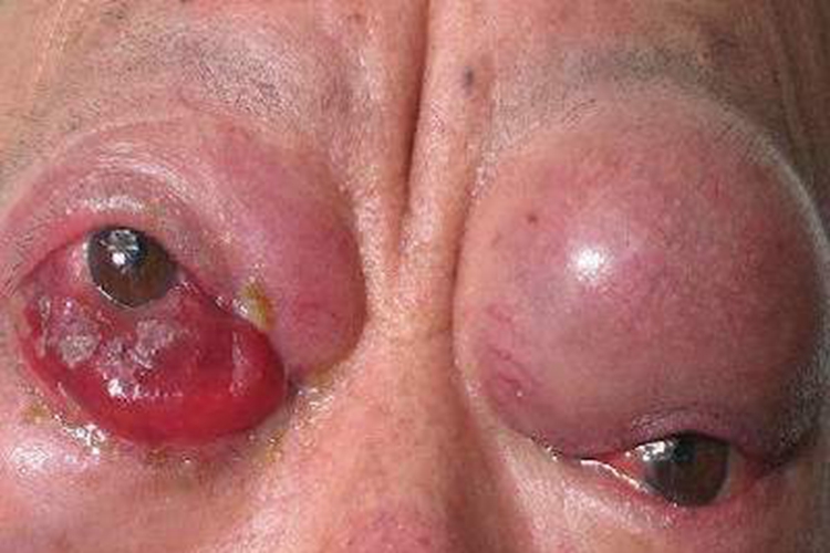 眼眶畸胎瘤症状图 眼眶畸胎瘤症状图