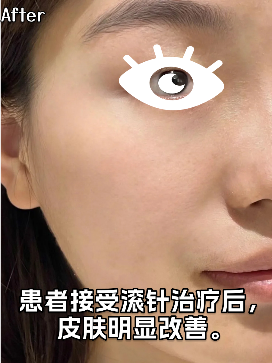 滚针也要有计划！多久做一次效果好？