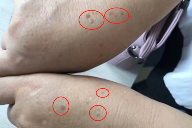 蛋白质营养不良斑图 蛋白质营养不良斑图