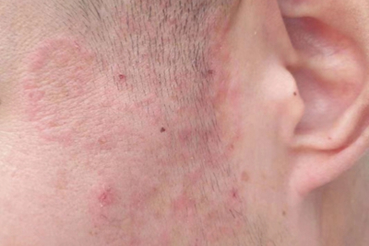 面癣面部血痂图