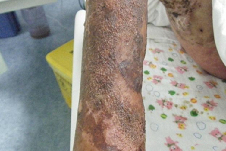急性放射性皮炎小腿结痂图