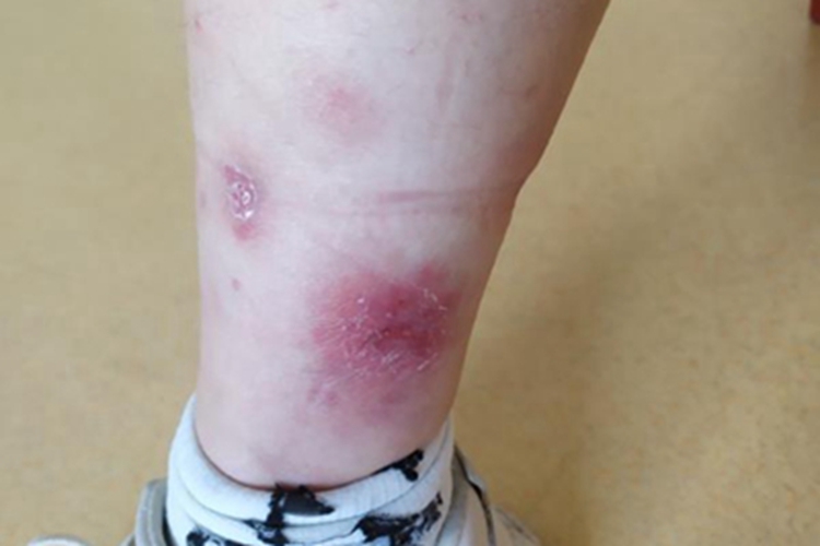 瘰疬性皮肤结核小腿症状图