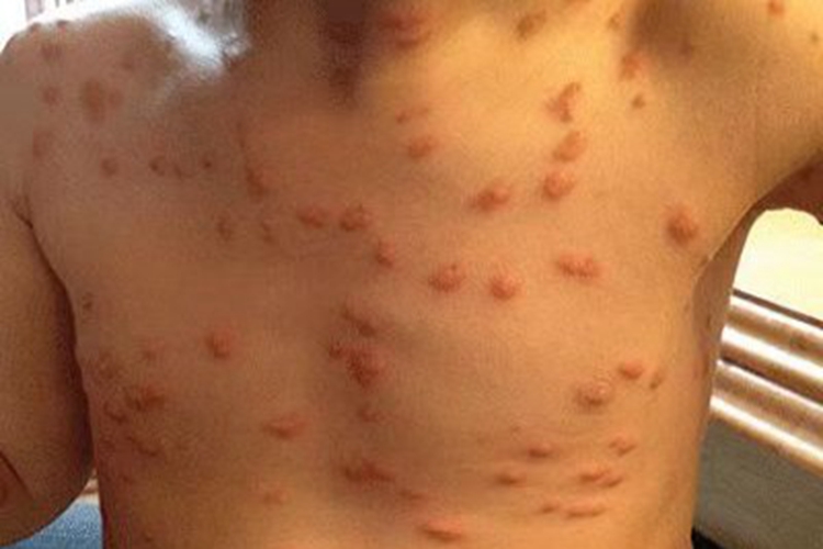 色素性荨麻疹症状图