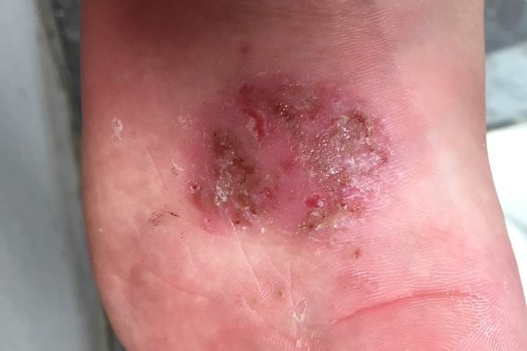 脚部真菌感染肿胀图