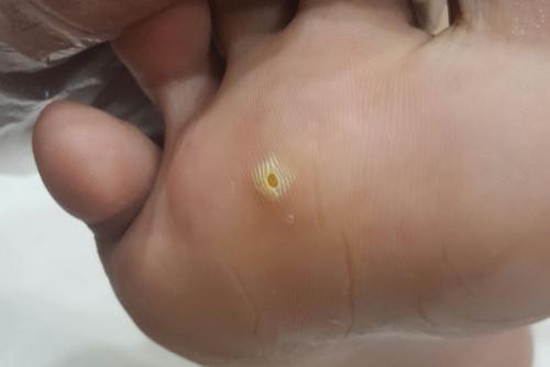 脚底跖疣图 脚底跖疣图