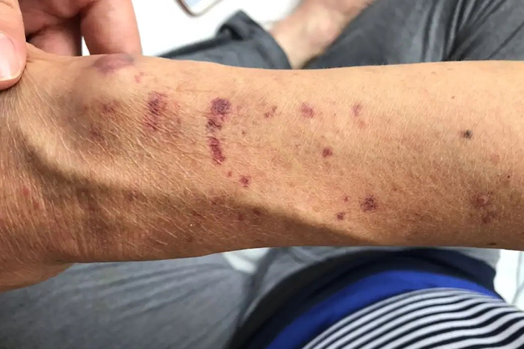手臂紫癜很多红斑图 手臂紫癜很多红斑图