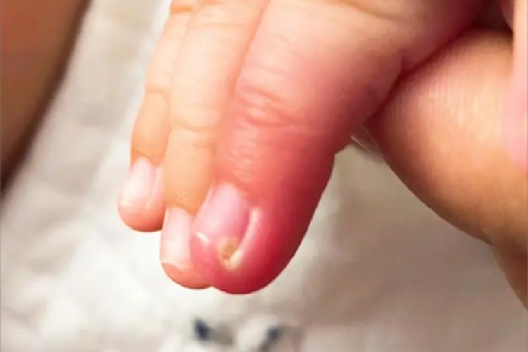 慢性甲沟炎手指严重红肿图