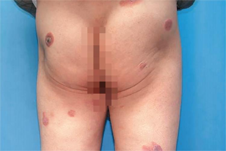 蕈样肉芽肿斑块期图 蕈样肉芽肿斑块期图