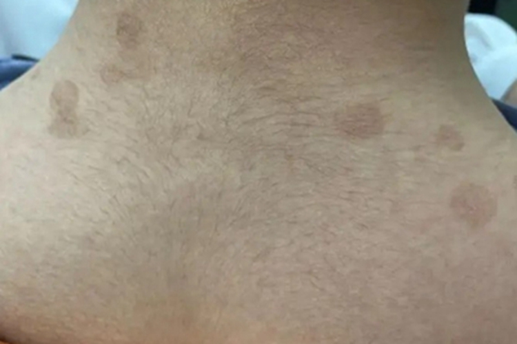 花斑糠疹背上有圆斑图