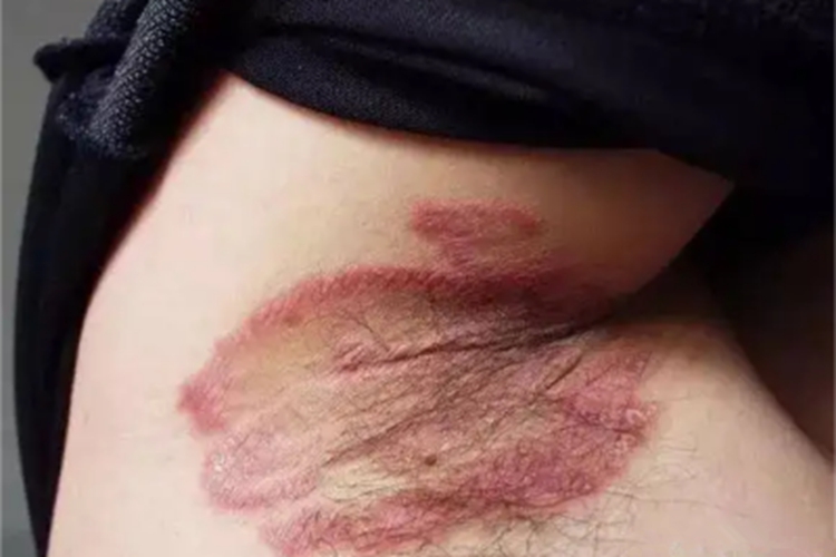 红斑性皮肤松弛症腋窝红斑图