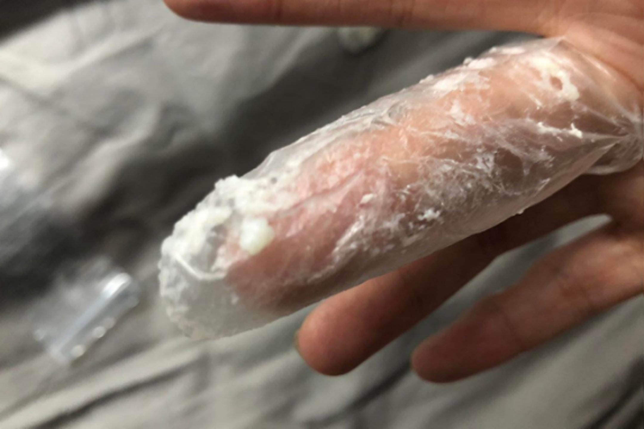 外阴阴道假丝酵母菌病豆腐渣样分泌物图