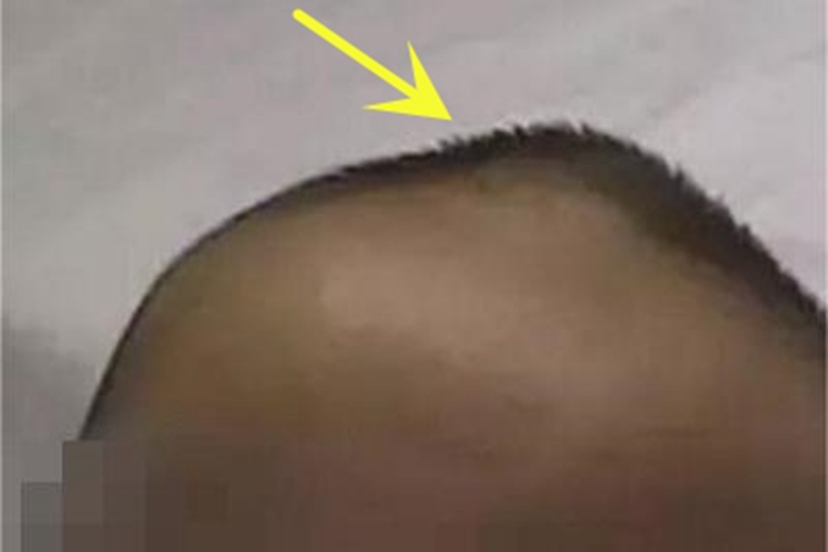 维生素A过多症头部硬包图