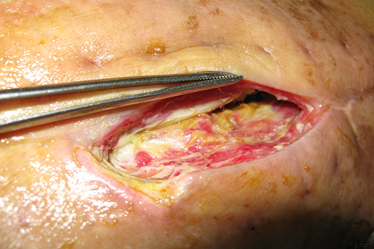 淡黄色油状渗出液图