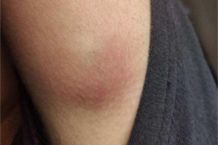 罗阿丝虫病红肿图 罗阿丝虫病红肿图