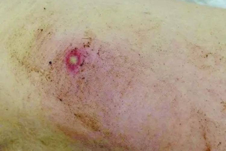 被蜜蜂蛰伤口中间发白图 被蜜蜂蛰伤口中间发白图