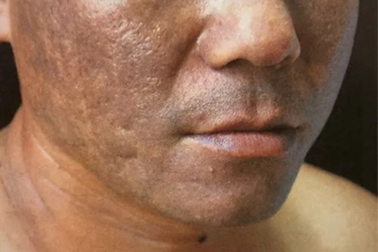 瑞尔黑变病皮肤发黑图