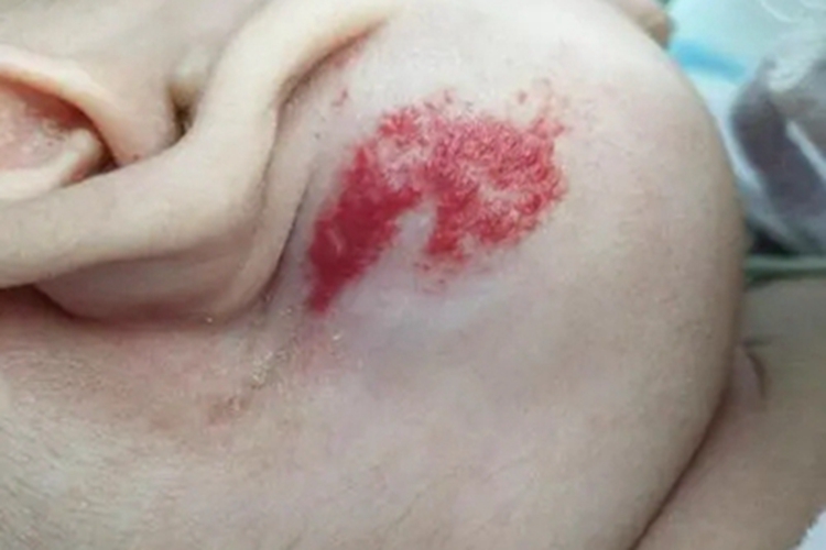 静脉畸形耳后症状图 静脉畸形耳后症状图