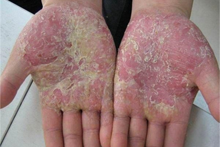 松皮癣手掌症状图