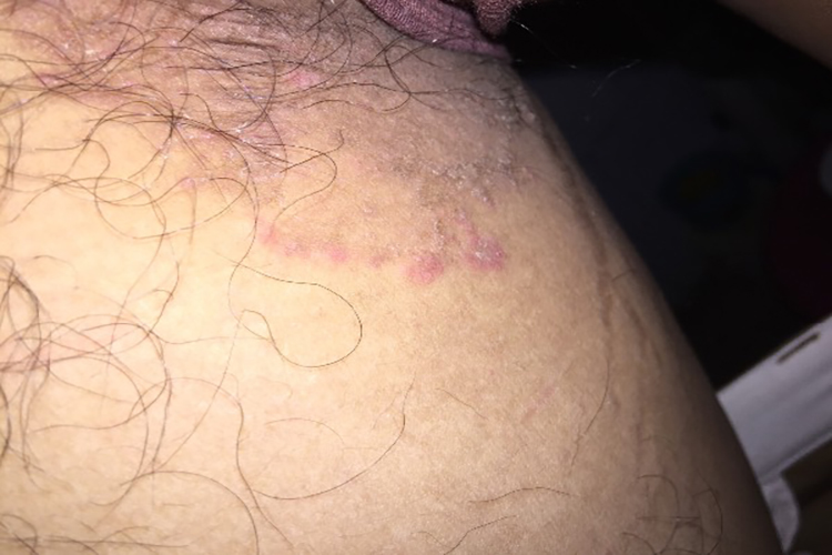 大腿根部阴囊两侧湿疹红斑图