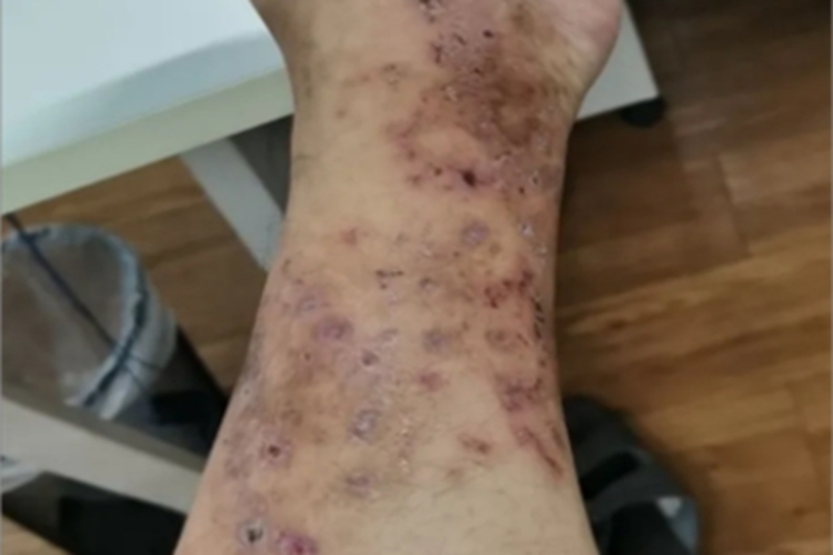 白色萎缩小腿破溃结痂图