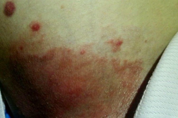 亚急性湿疹大腿症状图 亚急性湿疹大腿症状图