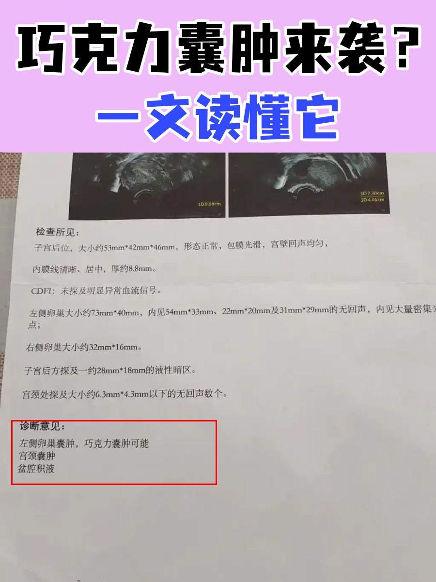 巧克力囊肿来袭？一文读懂它