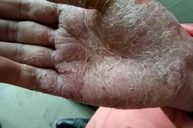 手部湿疹手掌出现裂纹脱皮图 手部湿疹手掌出现裂纹脱皮图