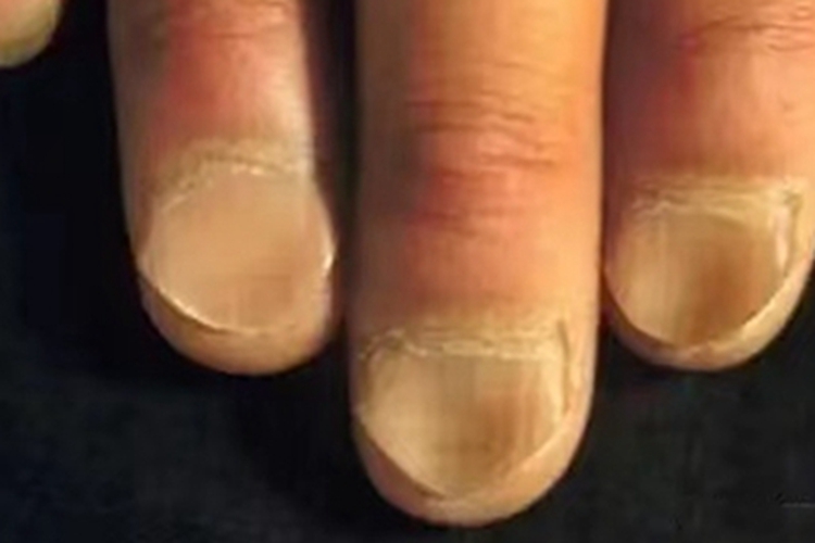 缺铁性贫血手指甲条纹图 缺铁性贫血手指甲条纹图