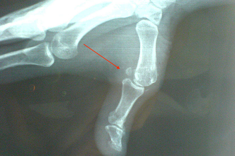 大拇指半脱位影像图