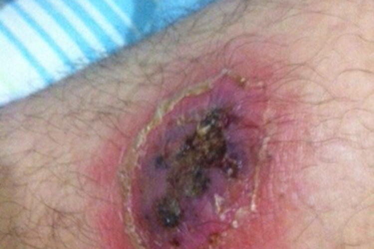 蜂窝织炎皮肤发紫图