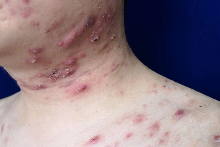 聚合性痤疮图